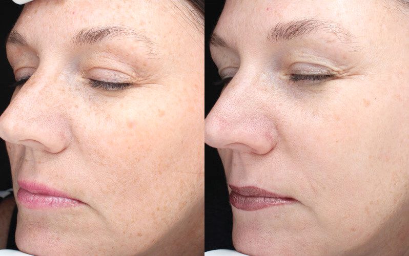 Hyperpigmentation 07