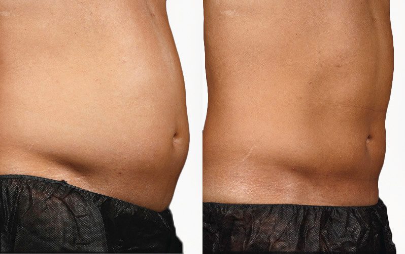 Sculpsure 07