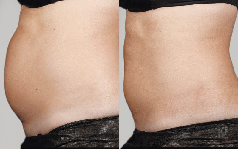 Sculpsure 18