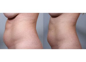 BodyFX 1 sm