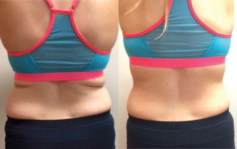 SculpSure 02