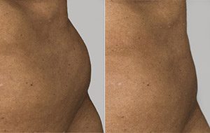 Sculpsure 01 sm 1