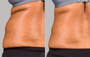 Sculpsure 02 sm 1