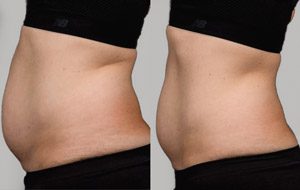 Sculpsure 04 sm