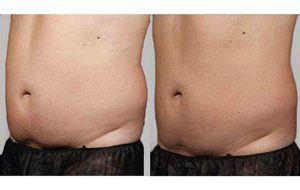 Sculpsure 06 sm 1