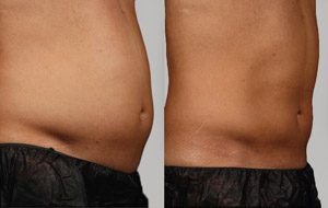 Sculpsure 07 sm