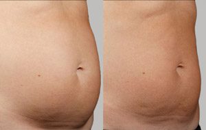 Sculpsure 08 sm 1