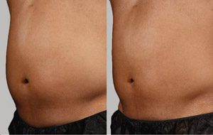 Sculpsure 09 sm 1