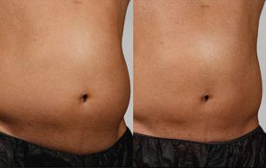 Sculpsure 10 sm 1