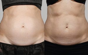 Sculpsure 11 sm 1