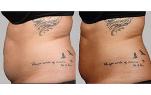 Sculpsure 13 sm 1