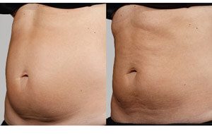 Sculpsure 14 sm 1