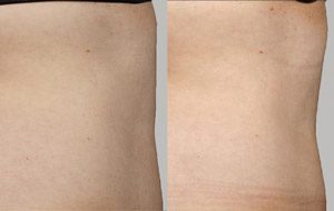 Sculpsure 15 sm 1