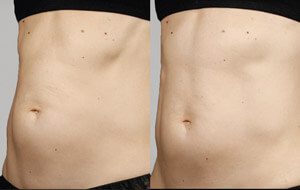 Sculpsure 16 sm 1