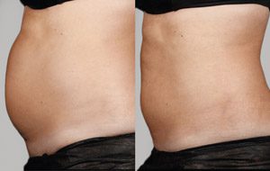 Sculpsure 18 sm