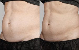 Sculpsure 19 sm 1