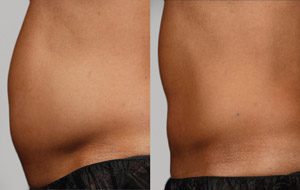 Sculpsure 20 sm 1