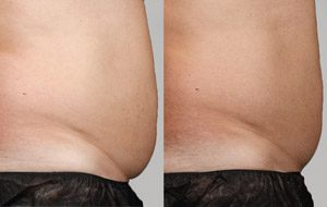 Sculpsure 22 sm 1