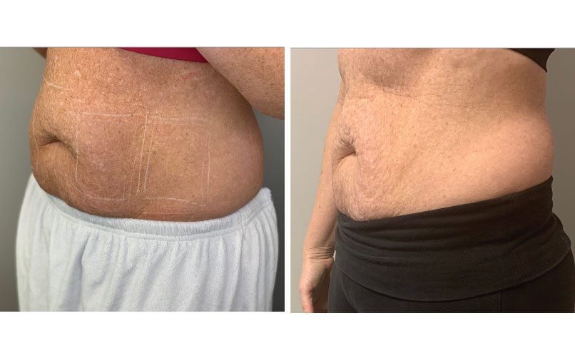 sculpt touch glp 1 reviews reddit weight loss Liposuction for Men: Sculpting Procedure for Male Body Contouring Beyond the Scale: How Sculptra