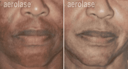 Melasma2 Pair