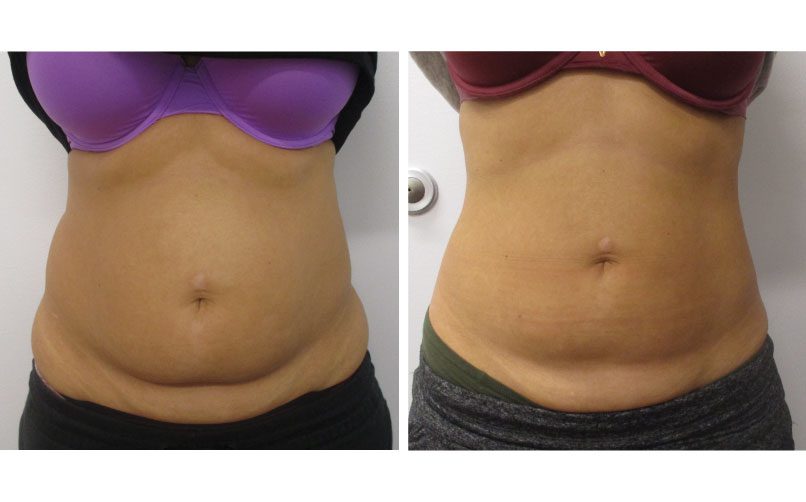 Laser Lipo Before & After Photos
