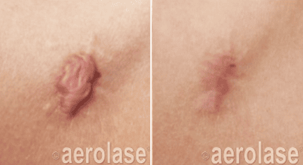 Scar Reduction4 Pair