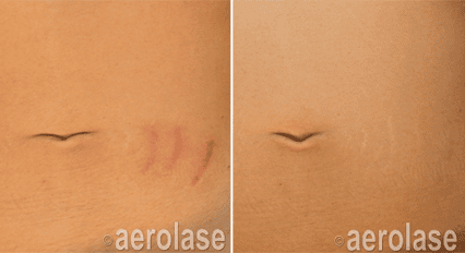 Scar Revision3 Pair