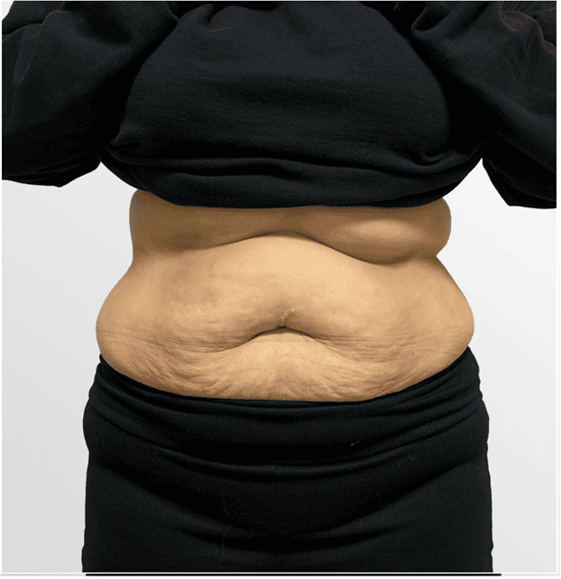 GLP-1 Weight Loss Injections & Support
